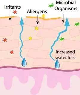 激素依赖性皮炎修复期什么样,激素依赖性皮炎怎么算彻底修复好