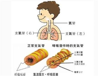 婴幼儿支气管炎怎么治断根,婴幼儿支气管炎怎么引起的