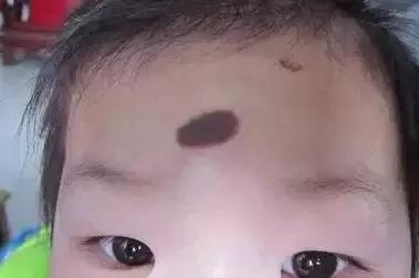 省̥妇̥幼̥专家提醒，宝宝出生有这些印记，一定要去！医！院！