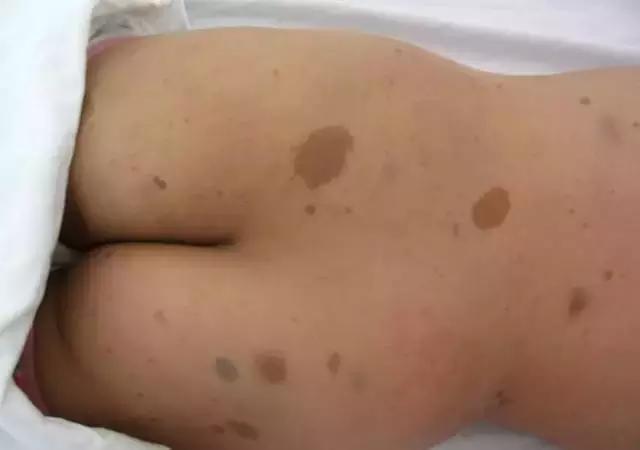 省̥妇̥幼̥专家提醒，宝宝出生有这些印记，一定要去！医！院！