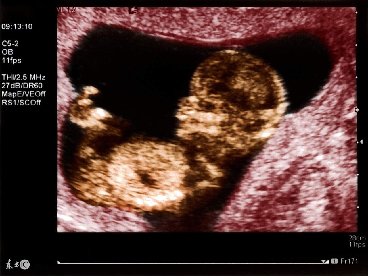 教你如何轻松看懂b超单,怎么看懂b超图和实际图