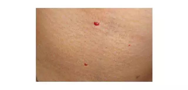 身上长了好多小红痣是怎么回事,出现小红痣不痛不痒