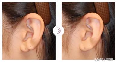 完美耳部成形术功能外观与福气集一身