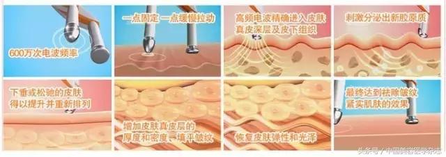 线雕面部提升女的,少女线雕术