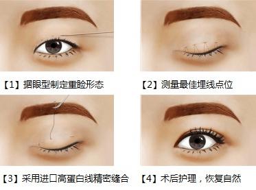 双眼皮原来这么简单自然无痕,做过的双眼皮如何看起来自然一些