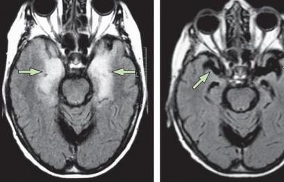 神经性脑炎治疗后遗症,脑炎后遗症失语最好的治疗