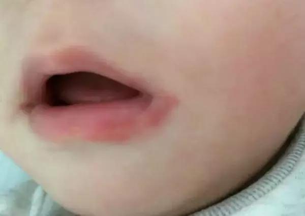 小孩常见的口腔问题如何治疗,小孩口腔各种疾病信号