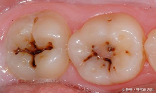蛀牙到牙齿脱落需要多久,蛀牙从牙根开始烂
