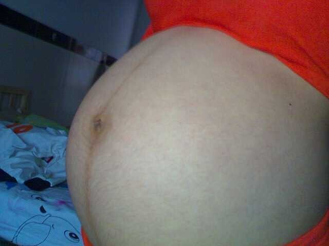 剖腹产时医生说子宫和膀胱粘连,一胎剖腹产子宫粘连