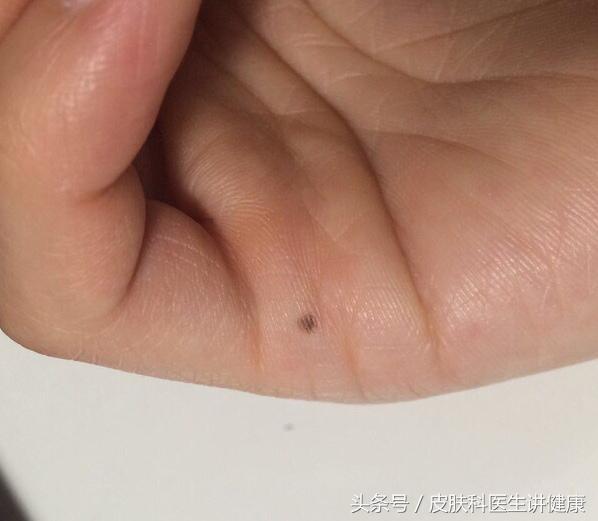 长在左眼旁边的色素痣会恶变吗,手心突然出现色素痣癌变几率