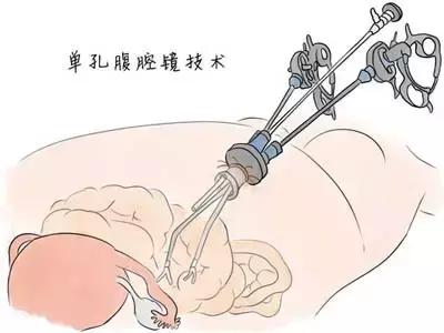 无瘢痕手术：单孔腹腔镜，让爱美女性不再为“疤”苦恼