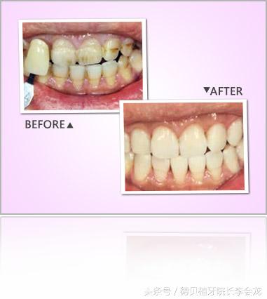 洗牙可以将四环素牙洗白吗,原来牙齿白现在变黄什么原因