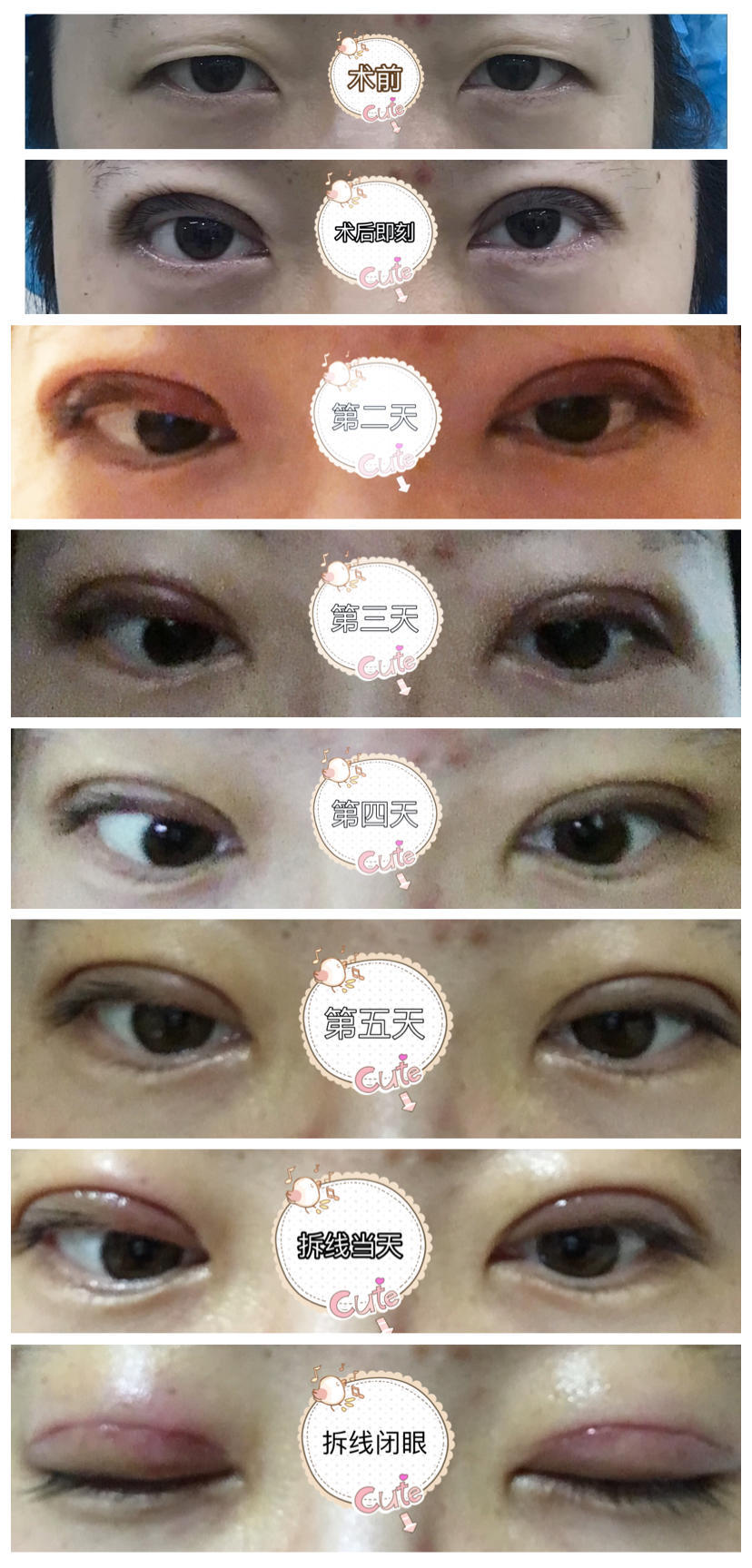 割双眼皮有哪些副作用呢,割双眼皮的利弊大揭秘