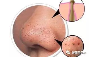 明星同款护肤品去黑头收缩毛孔,明星去黑头收缩毛孔好物推荐