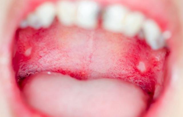 还需高度警惕口腔癌,口腔癌的真正罪魁祸首