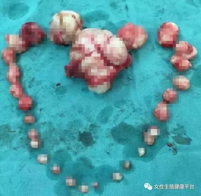 50岁女子10年长了108个子宫肌瘤,女子子宫肌瘤10年不治竟取出109颗