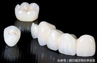 几百元一颗牙齿,几百一颗的牙贴面好吗