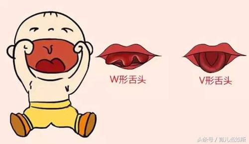 儿童剪舌筋最佳年龄,舌筋短什么时候剪最好