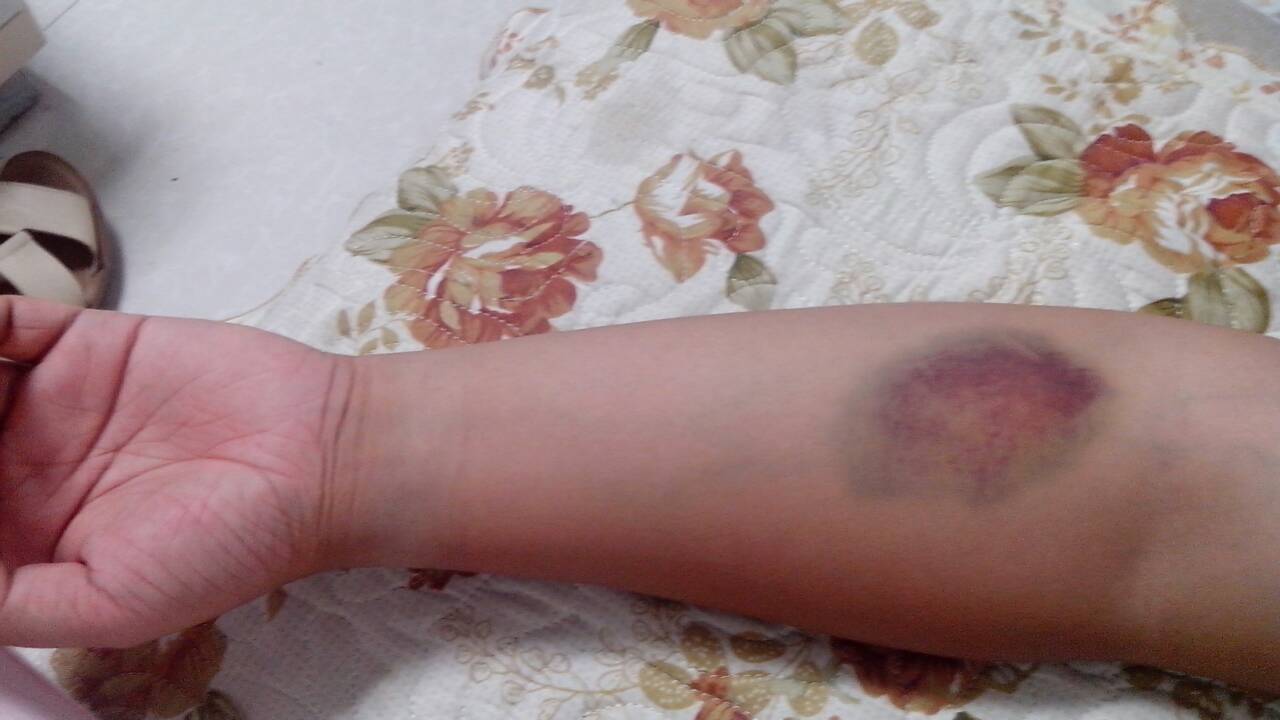 献血后的淤青多久消除,献血后的淤青