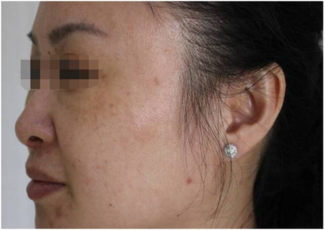 脸上突然出现很多褐斑,脸上褐斑的最好治疗方案