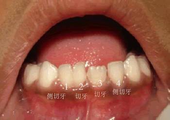 两个牙长在一起并融合了怎么办,两颗牙长在一起