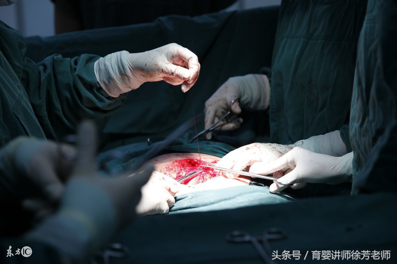 剖腹产后护理及注意事项有哪些,剖腹产产后怎样护理具体步骤