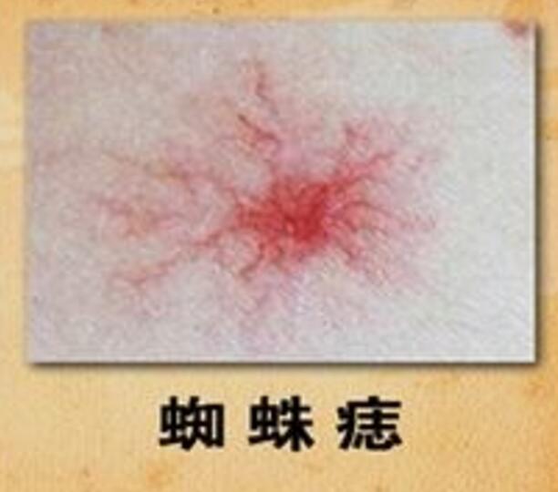 皮肤出现蜘蛛痣是不是肝硬化,皮肤出现蜘蛛