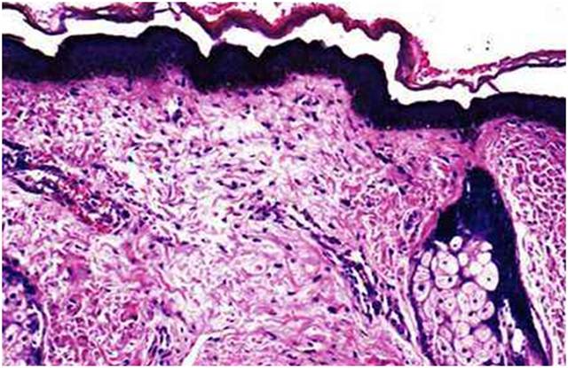 脸上突然出现很多褐斑,脸上褐斑的最好治疗方案