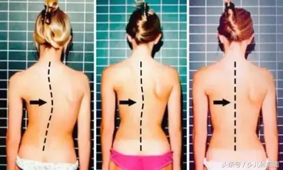 新苗脊柱侧弯预防中心是做什么的,用哑铃练背能预防脊柱侧弯