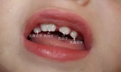 两个牙长在一起并融合了怎么办,两颗牙长在一起