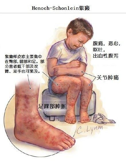 过敏性紫癜是一种什么病严重吗,过敏性紫癜会和荨麻疹同时发病吗