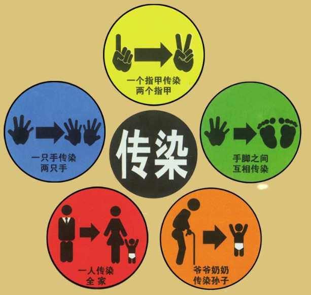 脚上灰指甲会传染给同伴吗,怎么防止灰指甲传染其他指甲