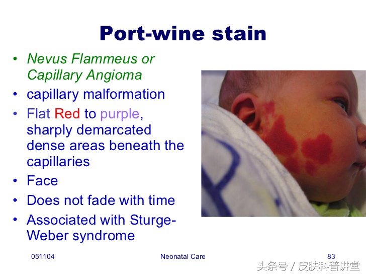 鲜红斑痣和新生儿红胎记区别,激光染料治疗网状鲜红斑痣的效果