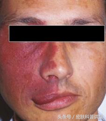 冷冻可以治疗鲜红斑痣胎记吗,治疗鲜红斑痣胎记的方法有哪些