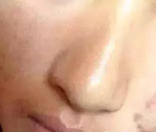 为什么会长了好多小米粒疙瘩,背后长了一粒小米粒