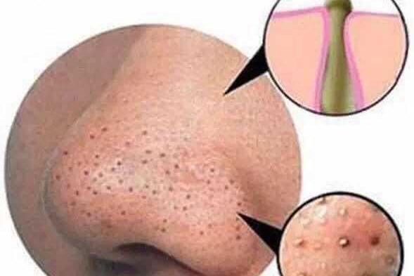 如何去黑头收缩毛孔最简单,怎么去黑头收缩毛孔小妙招