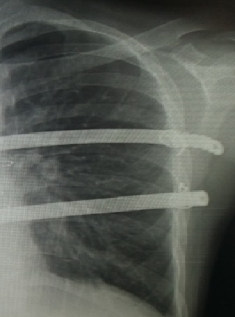 胸廓畸形能恢复吗,高难度胸廓畸形手术