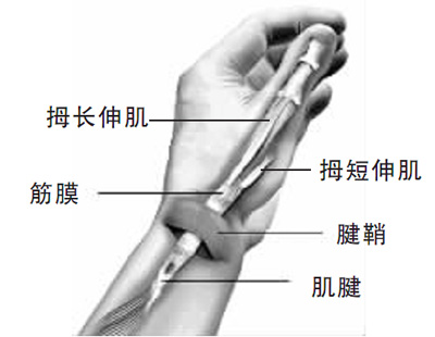 手指腱鞘炎怎么治,膏药能治腱鞘炎吗