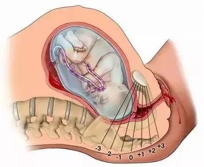 侧切和剖腹产哪个最疼,侧切与剖腹产哪个更难受