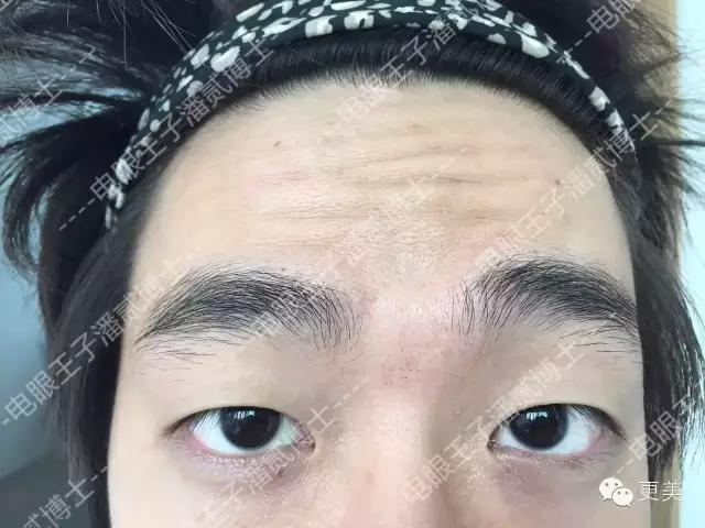 抬头纹手术会不会影响眼睛,抬头纹手术后有后遗症吗