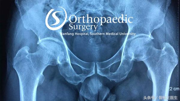 香港产关节疼痛特效药,关节炎香港特效药