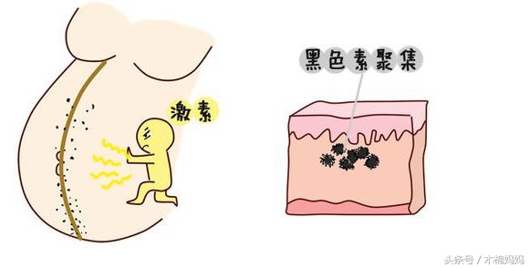 怀孕五个月老公让我打胎,怀孕后妊娠线靠左怎么回事