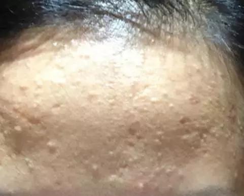 朵嘉浓晓晓:闭合粉刺的成因和预防