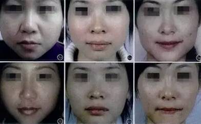 瘦脸针防止凹陷,瘦脸针注意避坑