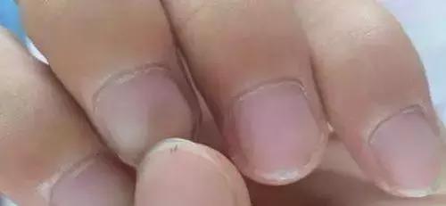 指甲竖纹变少了,指甲竖纹发白没血色