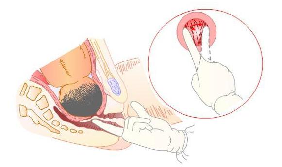 侧切宫缩,内检顺产和剖腹产都要做吗