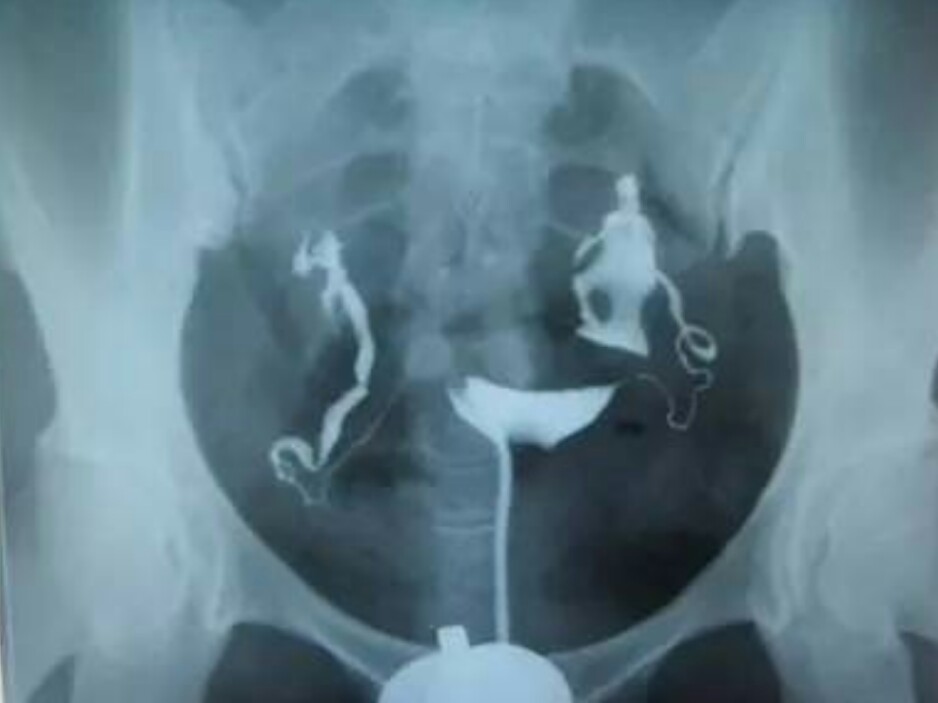 怎么改善让输卵管通畅,怎么让输卵管通畅