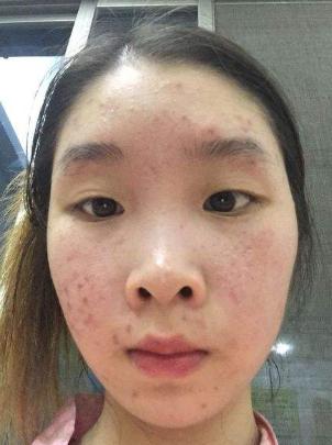 毛孔缩小最有效的方法,缩小毛孔5个最佳方法