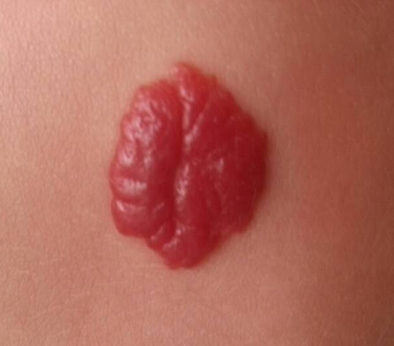 丢失孩子出生时脖子后面有胎记,婴儿出生胎记用不用去除