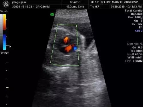 30周胎儿心室强光斑2mm,产检胎儿心脏有斑是怎么回事